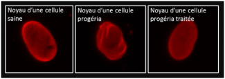 illustr progeria